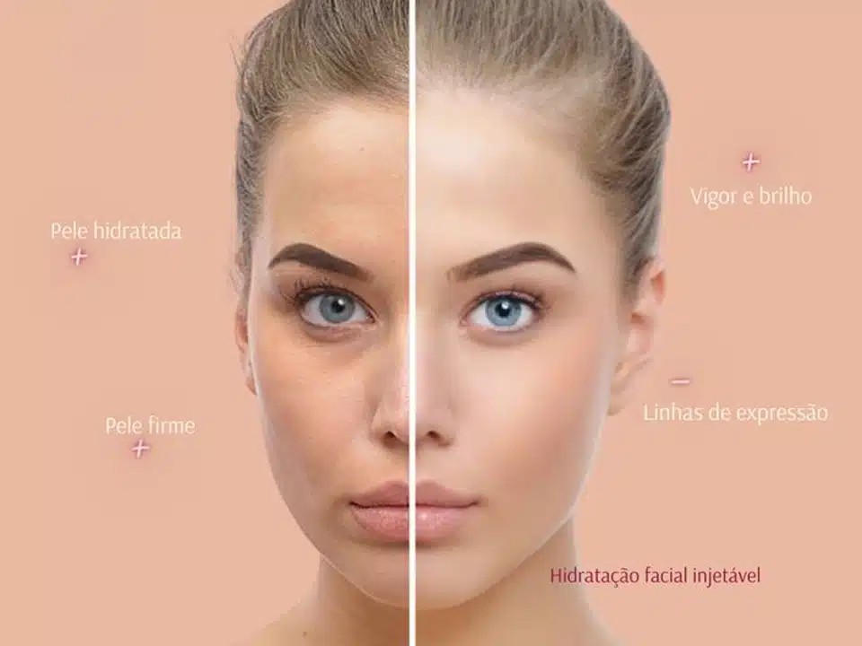 Intradermoterapias (Skinbooster)