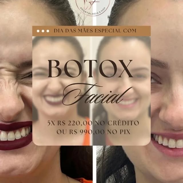 💥 PROMOÇÃO DE DIA DAS MÃES 💥 Botox com condição especial para você se sentir ainda mais linda! ✨ Mas corre, porque: ⚠️ São POUCAS vagas ⏳ 